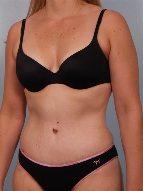 Tummy Tuck After Photo | Phoenix and Scottsdale, AZ | Scottsdale Center for Plastic Surgery