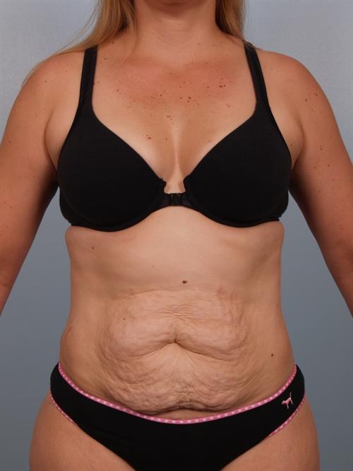 Tummy Tuck Before Photo | Phoenix and Scottsdale, AZ | Scottsdale Center for Plastic Surgery