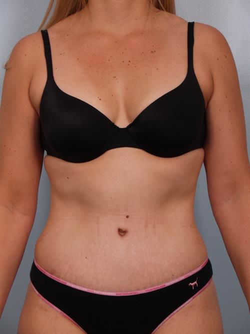 Tummy Tuck After Photo | Phoenix and Scottsdale, AZ | Scottsdale Center for Plastic Surgery