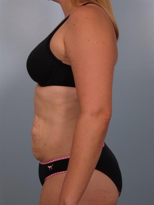 Tummy Tuck Before Photo | Phoenix and Scottsdale, AZ | Scottsdale Center for Plastic Surgery