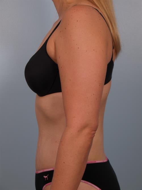 Tummy Tuck After Photo | Phoenix and Scottsdale, AZ | Scottsdale Center for Plastic Surgery