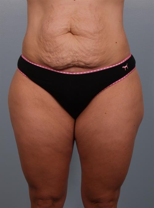 Tummy Tuck Before Photo | Phoenix and Scottsdale, AZ | Scottsdale Center for Plastic Surgery