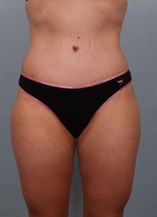 Tummy Tuck After Photo | Phoenix and Scottsdale, AZ | Scottsdale Center for Plastic Surgery