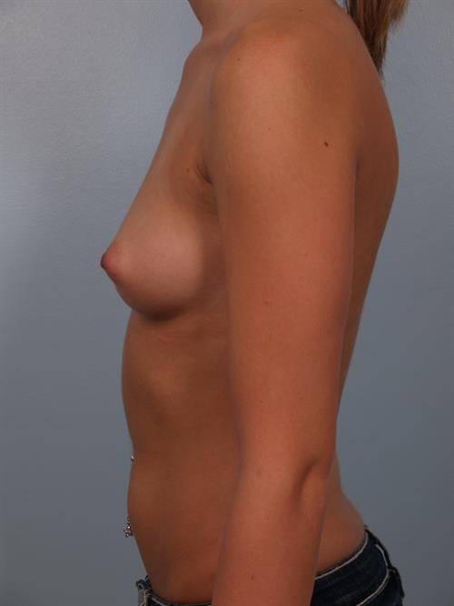 Breast Augmentation Before Photo | Phoenix and Scottsdale, AZ | Scottsdale Center for Plastic Surgery