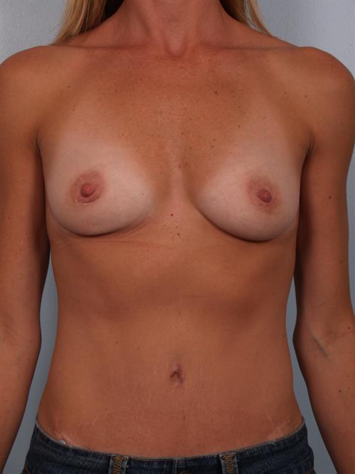 Breast Augmentation Before Photo | Phoenix and Scottsdale, AZ | Scottsdale Center for Plastic Surgery