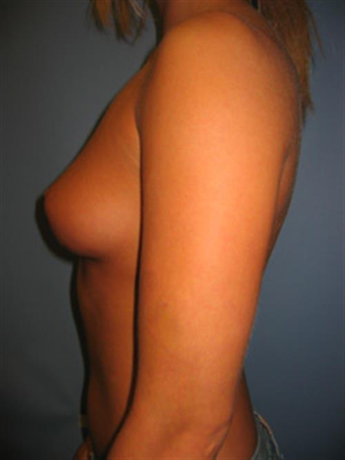Breast Augmentation Before Photo | Phoenix and Scottsdale, AZ | Scottsdale Center for Plastic Surgery