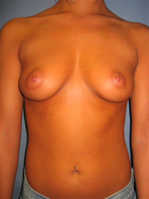 Breast Augmentation Before Photo | Phoenix and Scottsdale, AZ | Scottsdale Center for Plastic Surgery
