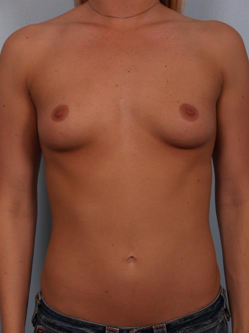 Breast Augmentation Before Photo | Phoenix and Scottsdale, AZ | Scottsdale Center for Plastic Surgery