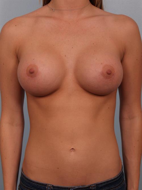 Breast Augmentation After Photo | Phoenix and Scottsdale, AZ | Scottsdale Center for Plastic Surgery