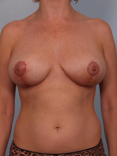 Breast Reduction After Photo | Phoenix and Scottsdale, AZ | Scottsdale Center for Plastic Surgery