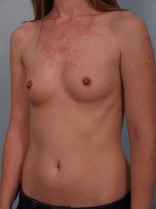 Breast Augmentation Before Photo | Phoenix and Scottsdale, AZ | Scottsdale Center for Plastic Surgery