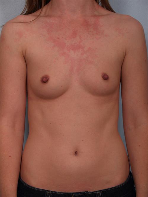 Breast Augmentation Before Photo | Phoenix and Scottsdale, AZ | Scottsdale Center for Plastic Surgery