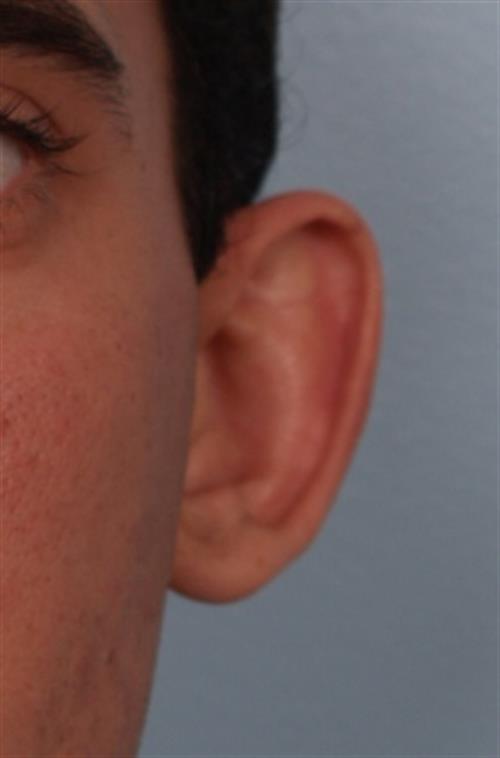 Otoplasty (Ear Reshaping) Before Photo | Phoenix and Scottsdale, AZ | Scottsdale Center for Plastic Surgery
