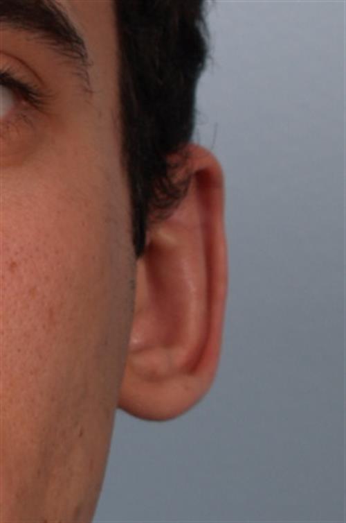 Otoplasty (Ear Reshaping) After Photo | Phoenix and Scottsdale, AZ | Scottsdale Center for Plastic Surgery