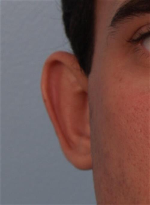 Otoplasty (Ear Reshaping) Before Photo | Phoenix and Scottsdale, AZ | Scottsdale Center for Plastic Surgery