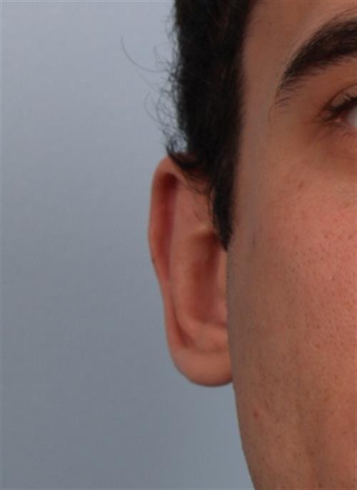 Otoplasty (Ear Reshaping) After Photo | Phoenix and Scottsdale, AZ | Scottsdale Center for Plastic Surgery