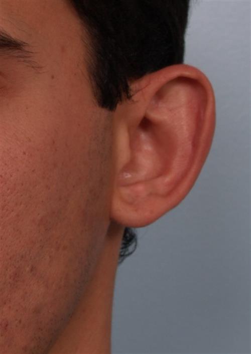 Otoplasty (Ear Reshaping) Before Photo | Phoenix and Scottsdale, AZ | Scottsdale Center for Plastic Surgery