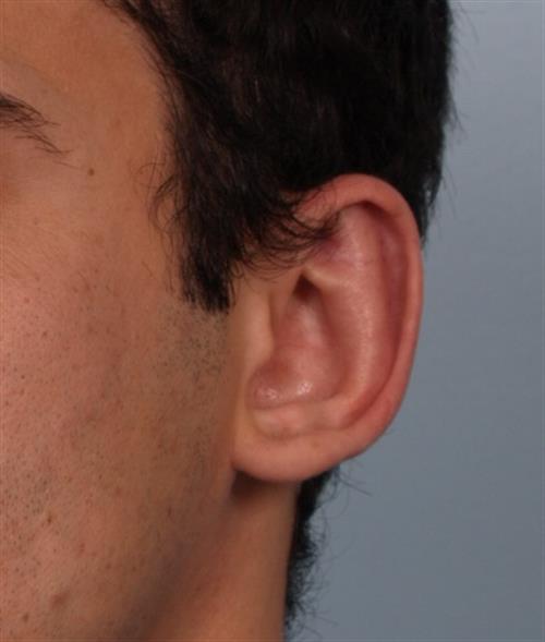Otoplasty (Ear Reshaping) After Photo | Phoenix and Scottsdale, AZ | Scottsdale Center for Plastic Surgery