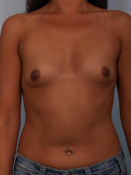 Breast Augmentation Before Photo | Phoenix and Scottsdale, AZ | Scottsdale Center for Plastic Surgery