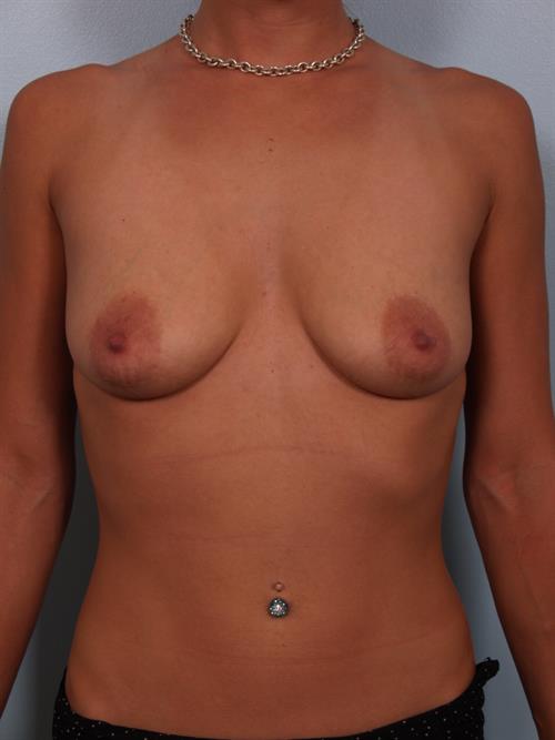 Breast Lift (Mastopexy) Before Photo | Phoenix and Scottsdale, AZ | Scottsdale Center for Plastic Surgery