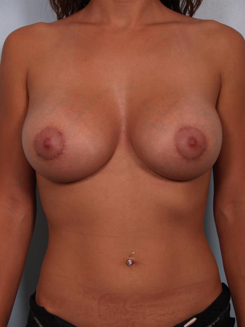 Breast Lift (Mastopexy) After Photo | Phoenix and Scottsdale, AZ | Scottsdale Center for Plastic Surgery