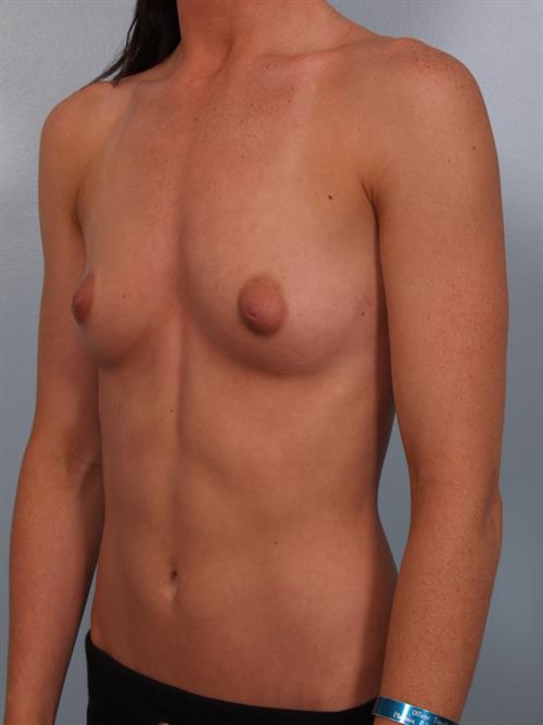 Breast Augmentation Before Photo | Phoenix and Scottsdale, AZ | Scottsdale Center for Plastic Surgery