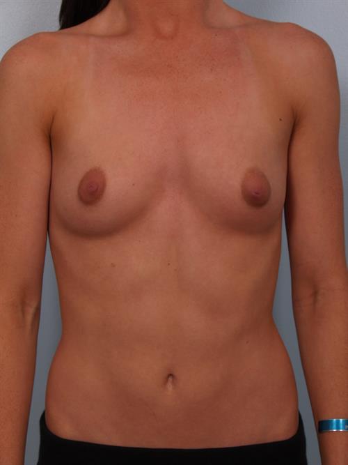 Breast Augmentation Before Photo | Phoenix and Scottsdale, AZ | Scottsdale Center for Plastic Surgery