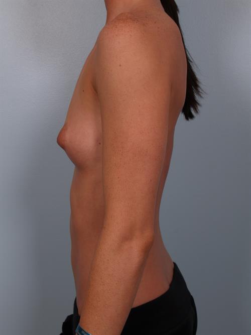 Breast Augmentation Before Photo | Phoenix and Scottsdale, AZ | Scottsdale Center for Plastic Surgery