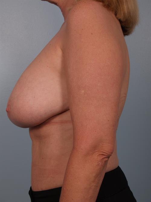 Breast Lift (Mastopexy) Before Photo | Phoenix and Scottsdale, AZ | Scottsdale Center for Plastic Surgery