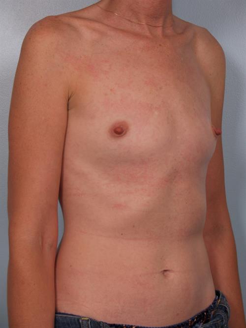 Breast Augmentation Before Photo | Phoenix and Scottsdale, AZ | Scottsdale Center for Plastic Surgery
