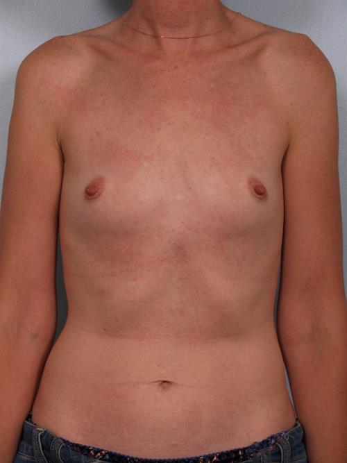 Breast Augmentation Before Photo | Phoenix and Scottsdale, AZ | Scottsdale Center for Plastic Surgery