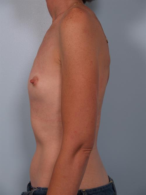 Breast Augmentation Before Photo | Phoenix and Scottsdale, AZ | Scottsdale Center for Plastic Surgery