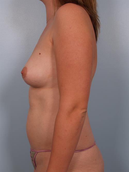 Breast Augmentation Before Photo | Phoenix and Scottsdale, AZ | Scottsdale Center for Plastic Surgery