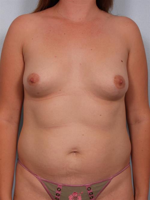 Breast Augmentation Before Photo | Phoenix and Scottsdale, AZ | Scottsdale Center for Plastic Surgery
