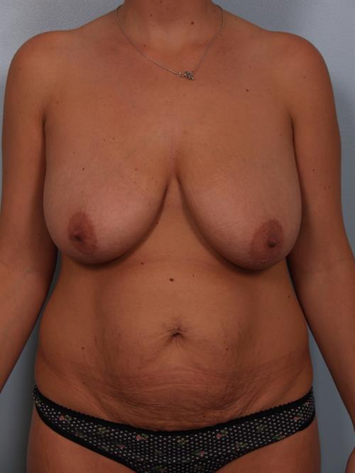 Mommy Makeover Before Photo | , |