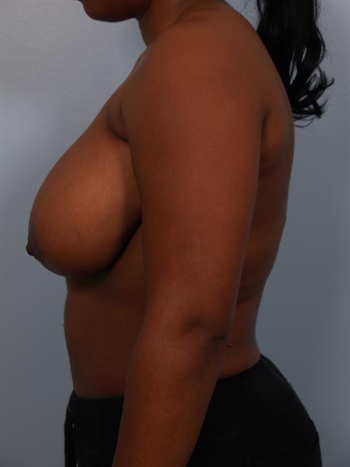 Breast Reduction Before Photo | Phoenix and Scottsdale, AZ | Scottsdale Center for Plastic Surgery