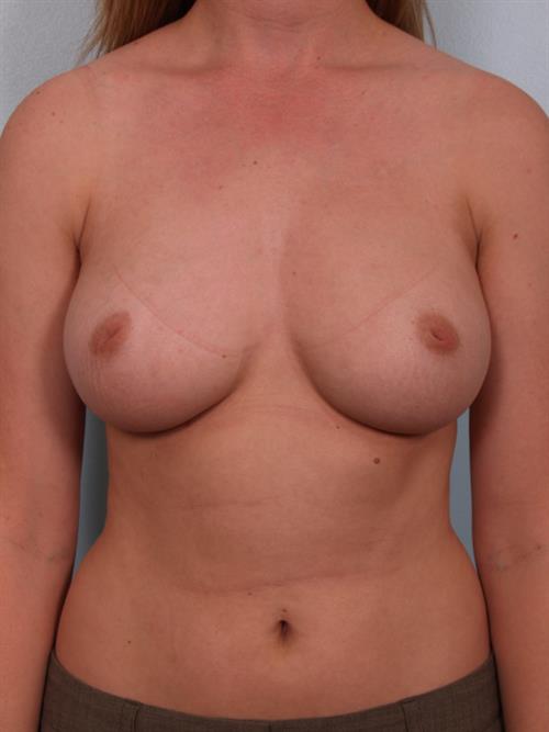 Nipple/Areolar Surgery Before Photo | Phoenix and Scottsdale, AZ | Scottsdale Center for Plastic Surgery