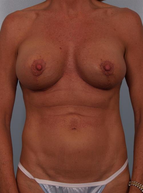 Revision Breast Surgery After Photo | Phoenix and Scottsdale, AZ | Scottsdale Center for Plastic Surgery