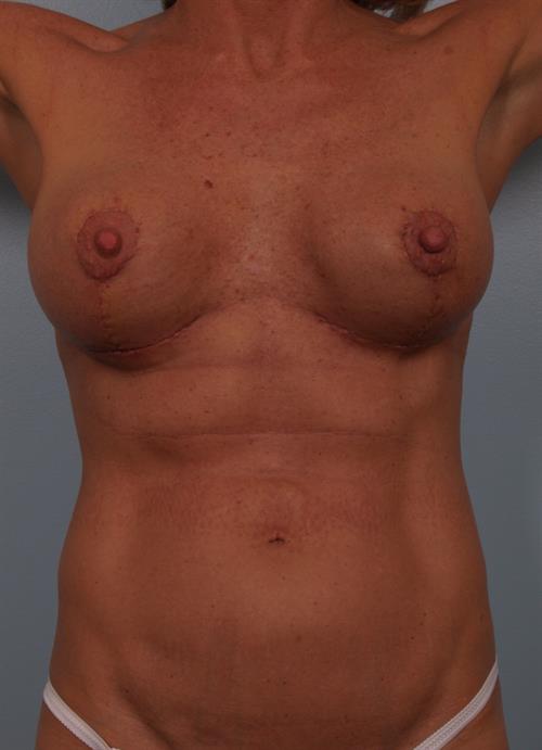 Revision Breast Surgery After Photo | Phoenix and Scottsdale, AZ | Scottsdale Center for Plastic Surgery