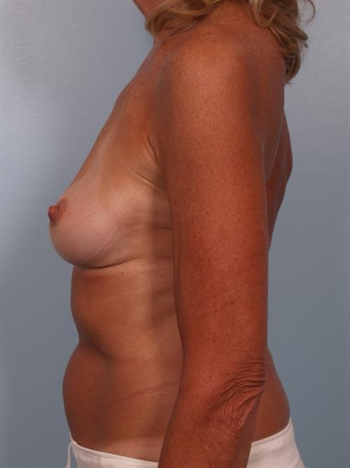 Revision Breast Surgery Before Photo | Phoenix and Scottsdale, AZ | Scottsdale Center for Plastic Surgery