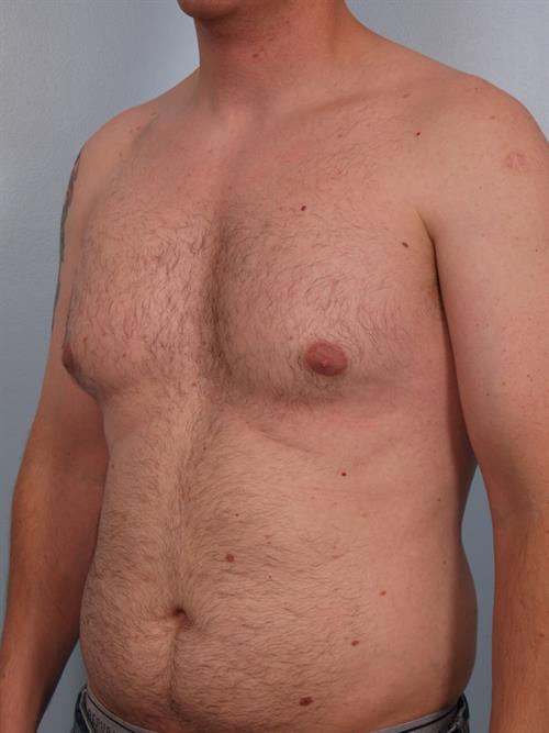Male Breast/Areola Reduction Before Photo | Phoenix and Scottsdale, AZ | Scottsdale Center for Plastic Surgery