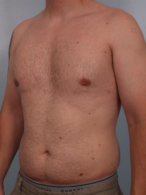 Male Breast/Areola Reduction After Photo | Phoenix and Scottsdale, AZ | Scottsdale Center for Plastic Surgery