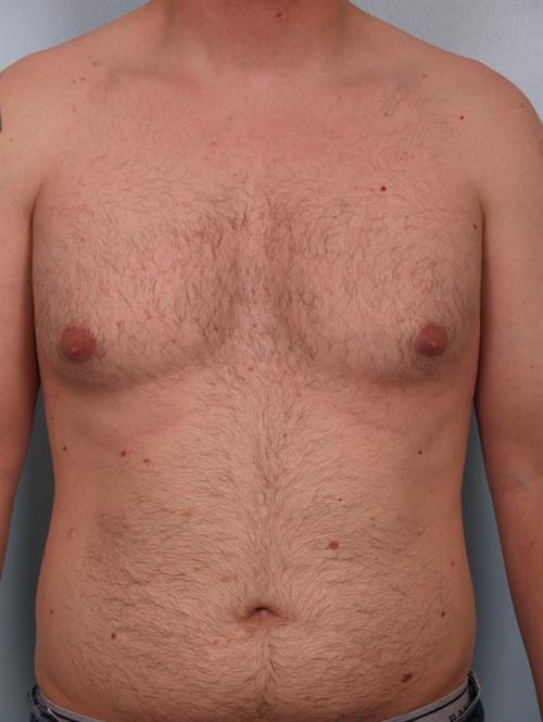 Male Liposuction Before Photo | Phoenix and Scottsdale, AZ | Scottsdale Center for Plastic Surgery