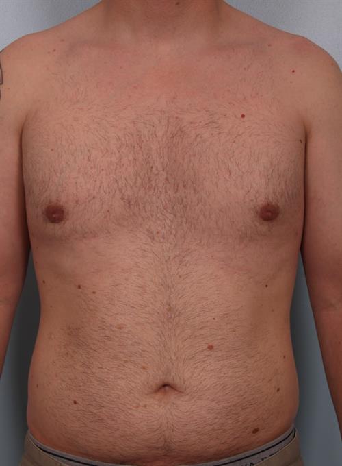 Male Liposuction After Photo | Phoenix and Scottsdale, AZ | Scottsdale Center for Plastic Surgery