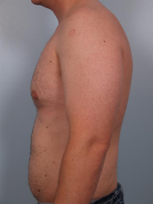 Male Liposuction Before Photo | ,  | 