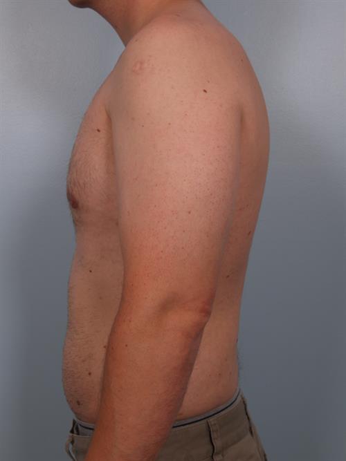 Male Breast/Areola Reduction After Photo | Phoenix and Scottsdale, AZ | Scottsdale Center for Plastic Surgery