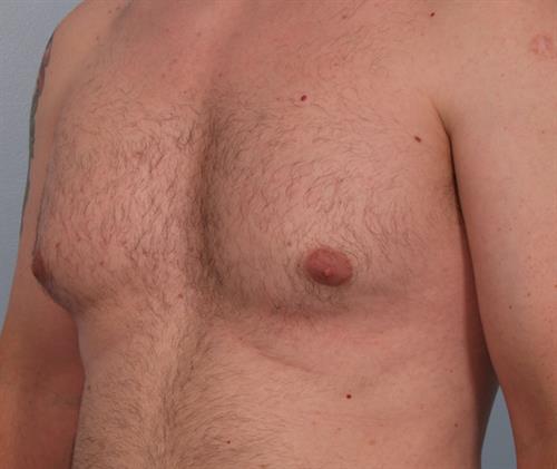Male Breast/Areola Reduction Before Photo | Phoenix and Scottsdale, AZ | Scottsdale Center for Plastic Surgery