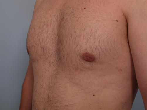 Male Breast/Areola Reduction After Photo | Phoenix and Scottsdale, AZ | Scottsdale Center for Plastic Surgery