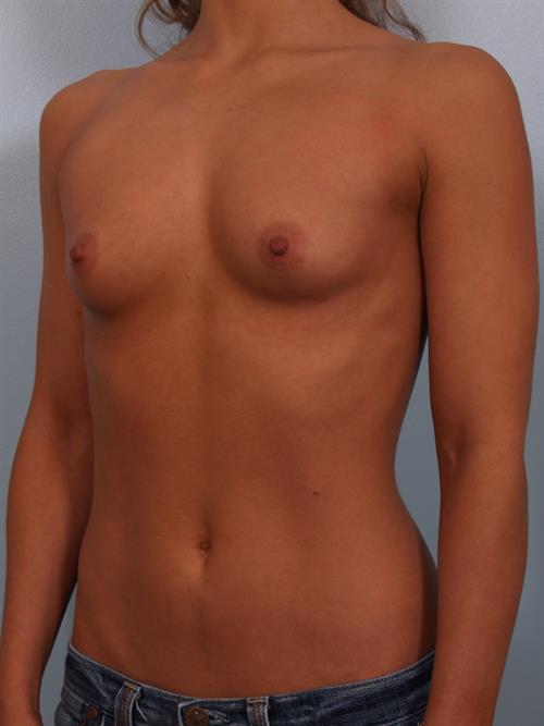 Breast Augmentation Before Photo | Phoenix and Scottsdale, AZ | Scottsdale Center for Plastic Surgery