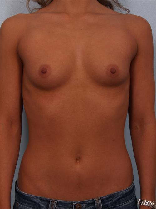 Breast Augmentation Before Photo | Phoenix and Scottsdale, AZ | Scottsdale Center for Plastic Surgery